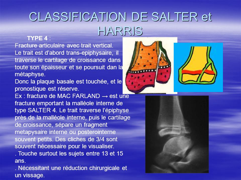 TRAUMATISMES CARTILAGE CROISSANCE ppt video online t l charger